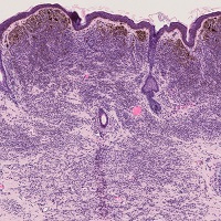 母斑細胞母斑
